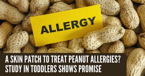 Skin patch shows promise in toddlers with peanut allergies